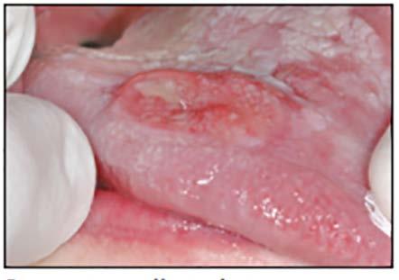 floor of the mouth, soft palate, tonsillar pillar area, and retromolar trigone areas.