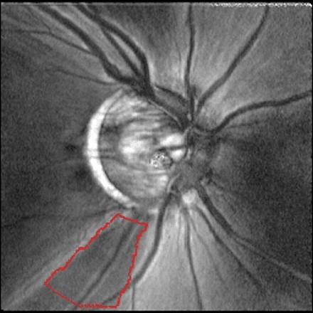 concentrated superiorly & inferiorly Ever do an OCT scan of the area around the optic nerve head (ONH)