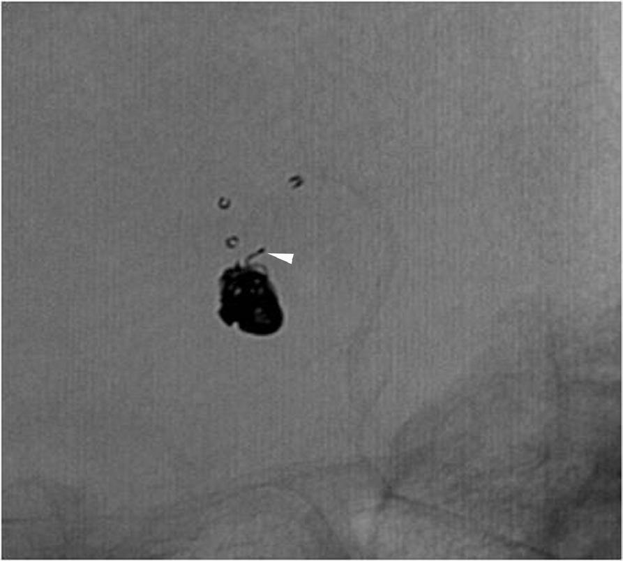 72-year-old man with ruptured anterior communicating artery aneurysm. A.