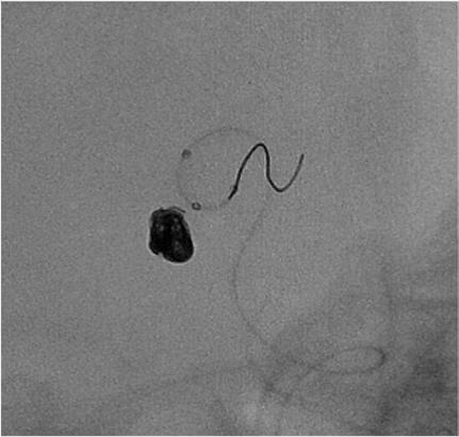 014-inch microguidewire that was prepositioned at anterior cerebral artery