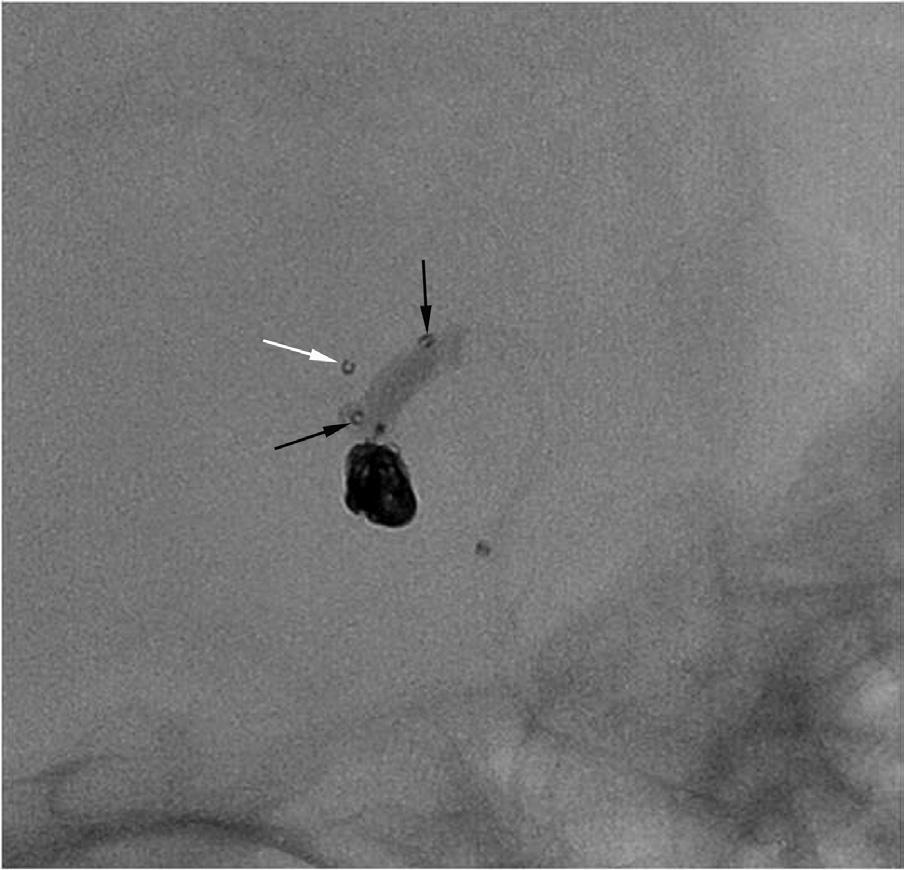 Scepter balloon-assisted coil embolization performed after removal of