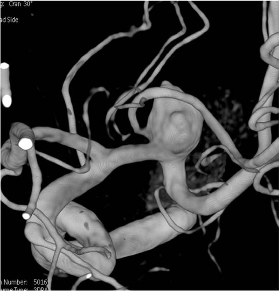 New Double-Lumen Scepter Balloon Catheter for Treating Wide-Necked Aneurysms A B C D Fig. 2. Case 2. 66-year-old woman with ruptured aneurysm at middle left cerebral artery. A. Three-dimension reconstruction angiogram reveals large aneurysm at middle left cerebral artery bifurcation.