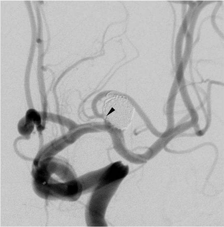 At end of procedure, small thrombus (black arrowhead) is detected at aneurysm neck, close to origin of superior branch. D.