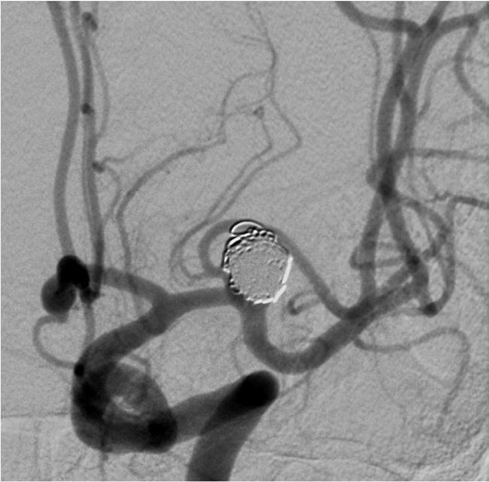 The final control angiogram revealed a complete occlusion of both aneurysms and well-preserved MCA superior and inferior divisions (Fig. 3C).