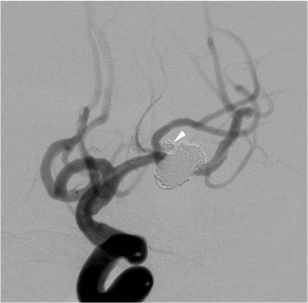 Three-dimensional reconstruction angiogram reveals large aneurysm at middle left cerebral artery bifurcation and another very small aneurysm (white arrowhead) close to aneurysm neck at superior