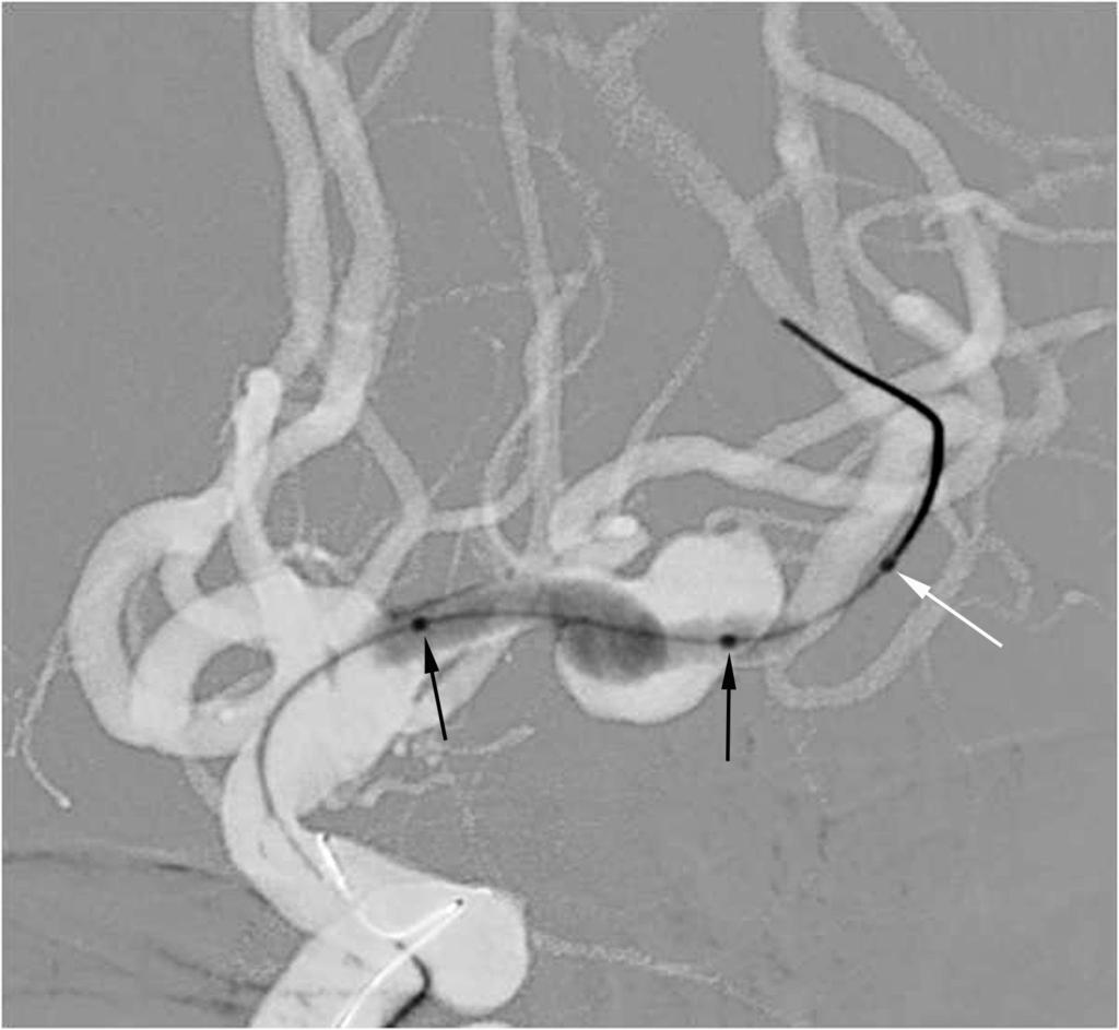 After balloon-assisted coil embolization of both aneurysms, final control angiogram shows complete occlusion of both aneurysms and well-preserved superior and inferior divisions.