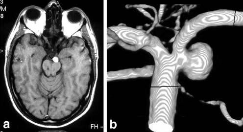 748 Neuroradiology (2007) 49:747 751 Fig. 1 Incidentally found SCA aneurysm in a 39-year-old man with vertebrobasilar embolic infarcts.