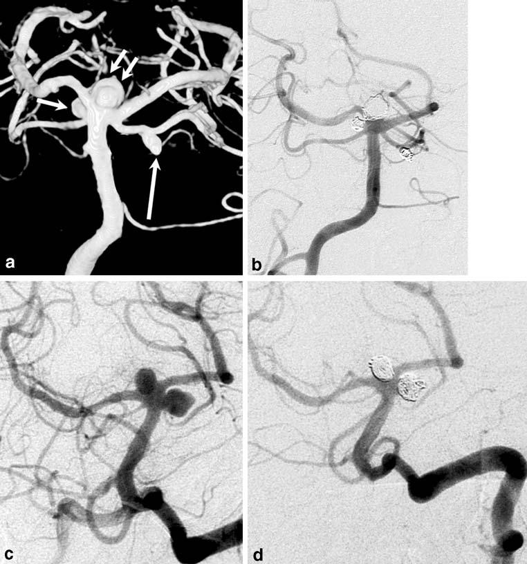 b 3-D vertebral angiogram reveals a small SCA aneurysm aneurysms, 36 aneurysms in 35 patients were located on the SCA, resulting in an incidence of 1.7% of all treated intracranial aneurysms and 11.