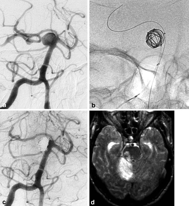 Neuroradiology (2007) 49:747 751 749 and were coiled in the same session as the ruptured aneurysm. The clinical condition of these six patients was HH I II in five and HH IV V in one.