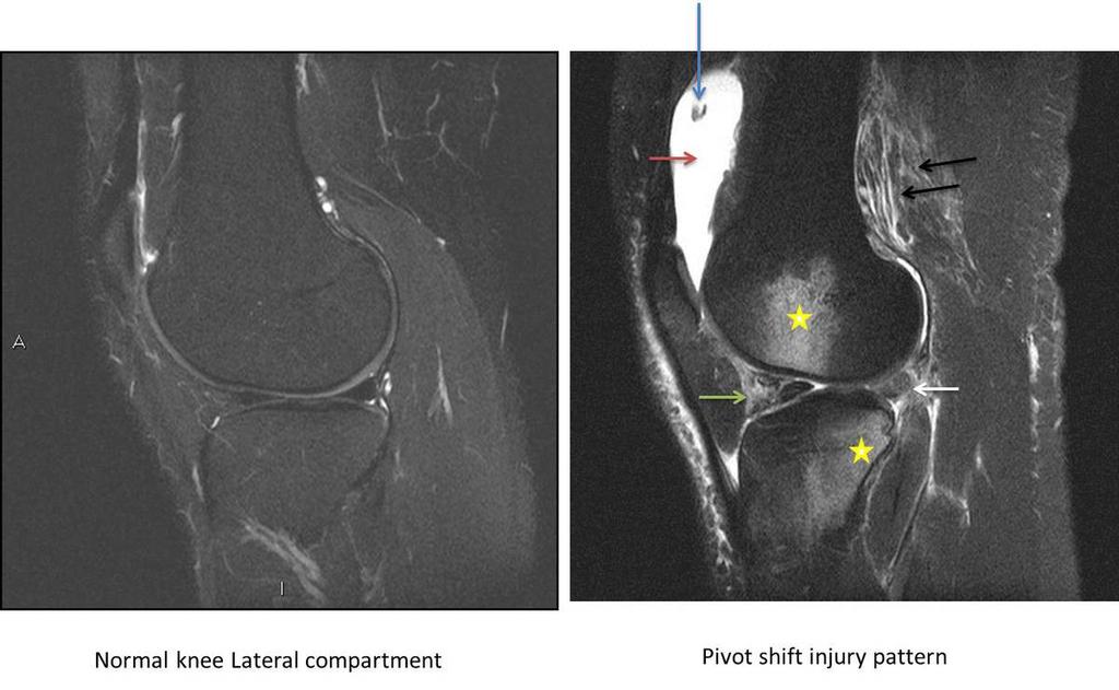 Fig. 1: Pivot shift injury: Large contusions in the lateral femoral condyle and posterolateral tibial plateau (yellow star).