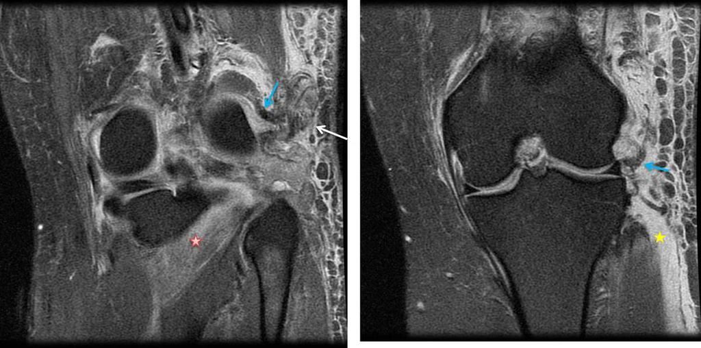 Fig. 28: Posterolateral corner injury with complete tear of the lateral collateral ligament (blue arrow) and biceps tendon (white arrow).
