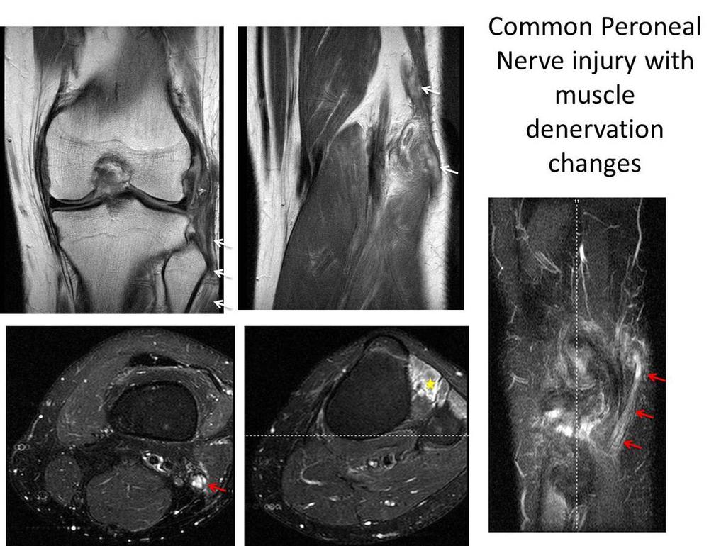 Fig. 29: The common peroneal nerve is injured with surrounding hematoma (white arrow) as seen on the coronal PD images.