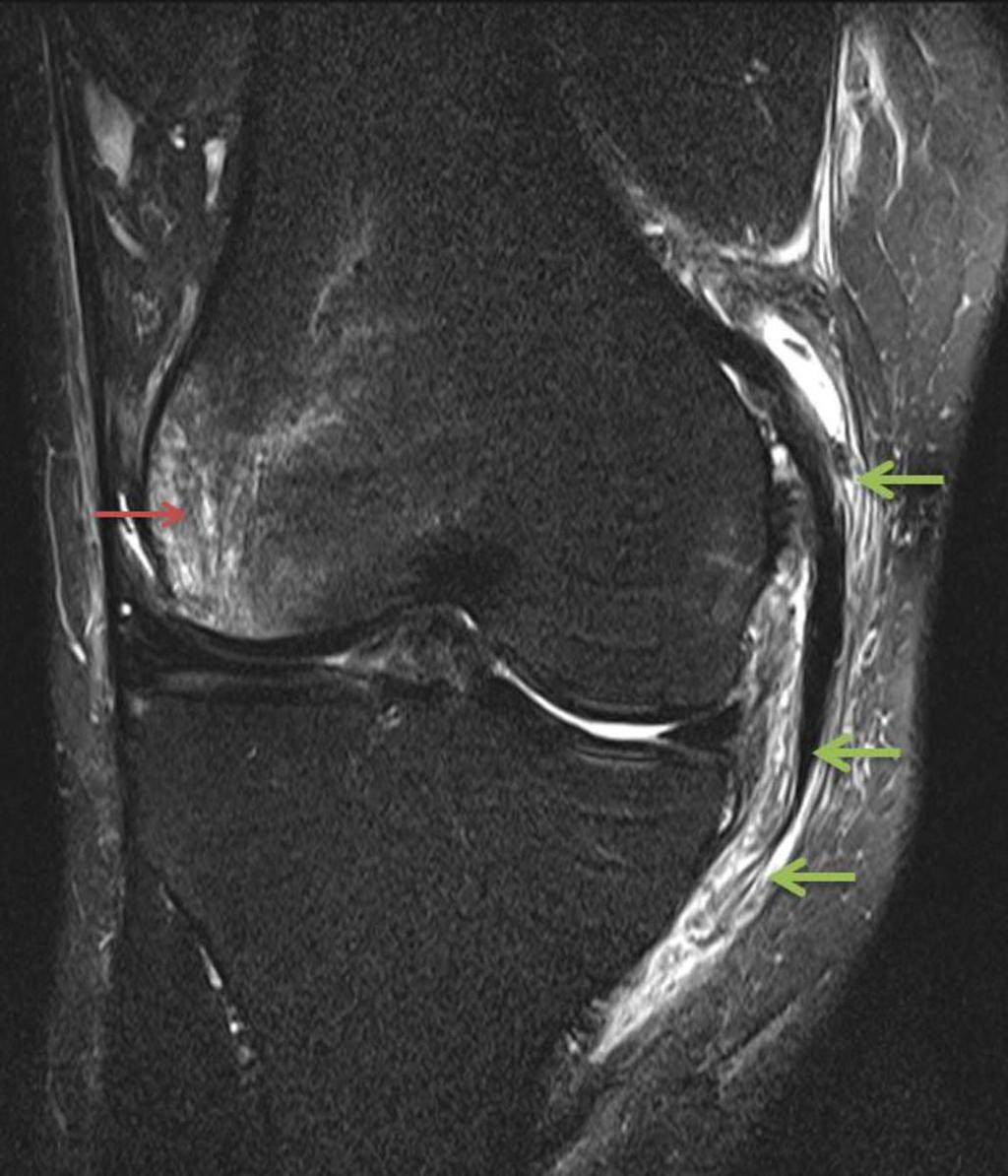 Fig. 2: Clip type of injury seen in contact sports with valgus stress to the knee.
