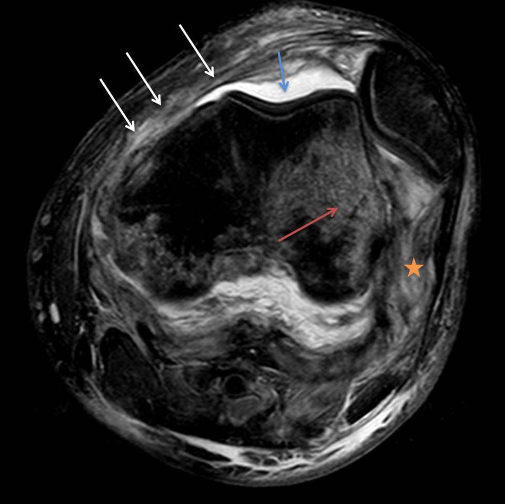 Fig. 3: Lateral patellar dislocation with large contusion in the lateral femoral condyle (red arrow), large