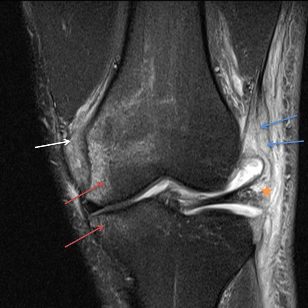 Fig. 4: Large bony contusions in the medial compartment involving the medial femoral condyle and medial tibial plateau (red arrow), with complete tear of proximal medial collateral ligament (white