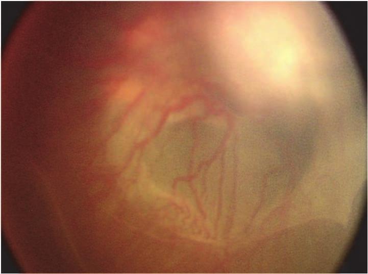 388 Telemedicine Techniques and Applications Fig. 8. Stage 5 Retinopathy of prematurity: Total retinal detachment.