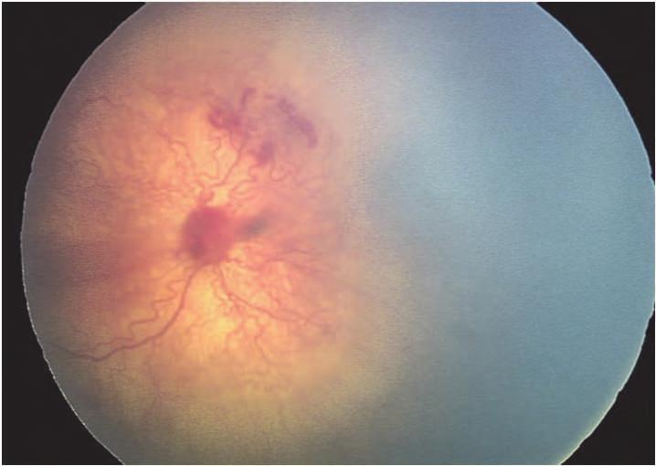 demonstrates more arterial tortuosity and more venous dilation than normal. Fig. 11. Aggressive posterior retinopathy of prematurity.