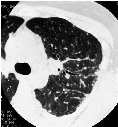 HEENT: 1 cm left supraclavicular fossa lymph node, mobile and nontender. LUNGS: Symmetric expansion. No dullness to percussion.