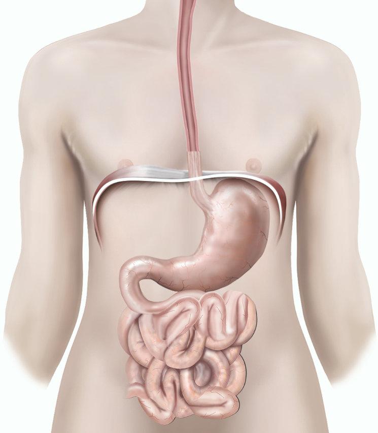 What is a gastric bypass?