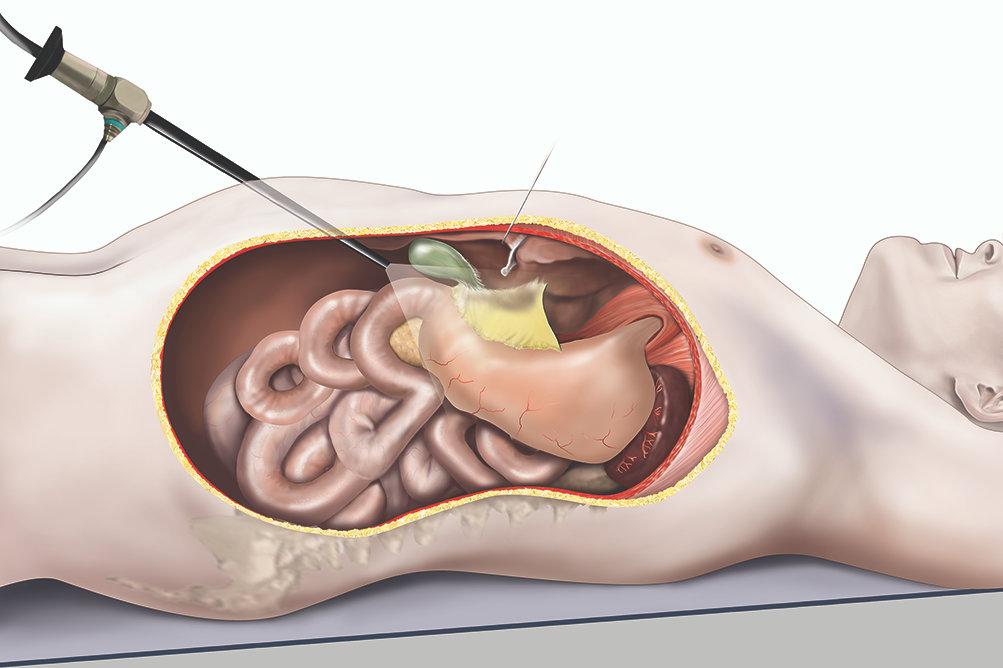 Gastric banding Inserting an adjustable silicone band around the upper part of your stomach.