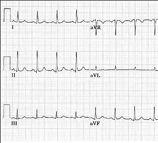 Hypocalcemia d. None of the above 26. Using the above telemetry strip, what is the rhythm? 27.