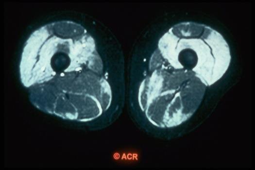Muscle MRI can show
