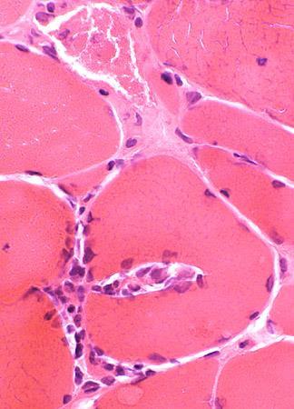 Myositis = muscle inflammation http://www.neuro.