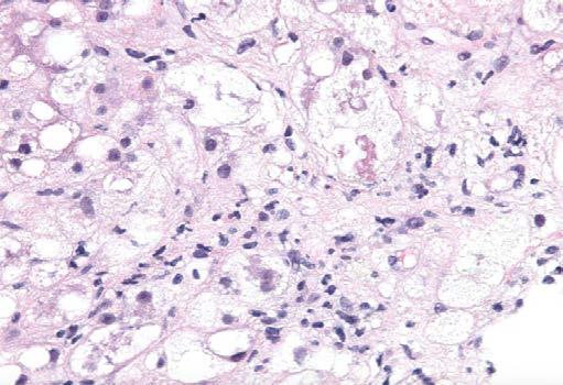 Neutrophilic lobular inflammation (black arrow), Mallory-Denk bodies (red arrow), pericellular fibrosis Histology can be
