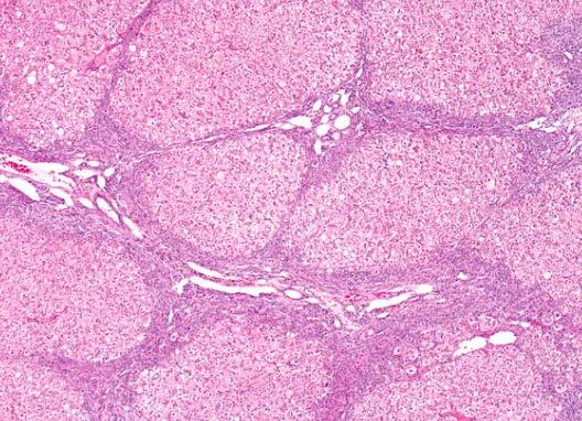 necrosis Chronic cases can lead to central vein and sinusoidal fibrosis Cirrhosis aka Veno-Occlusive Disease Cirrhosis