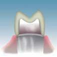crowns, the labial and/or palatal/lingual surfaces should be reduced by at least 1.0 mm.