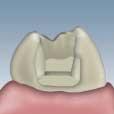 The bucco-lingual cavity width should be at least 3.