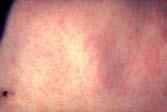 Roseola Infantum : Herpes 6 Measles -Fever (up to 104)