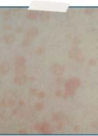 Tinea Versicolor! Scaling, ovale, patchy!