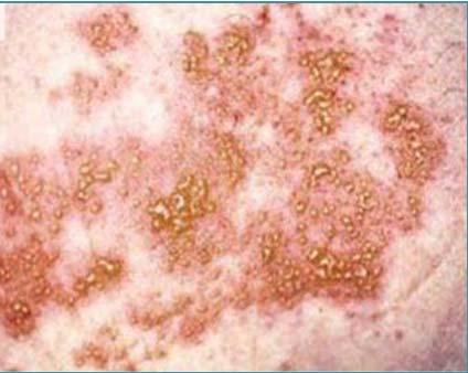 If had chickenpox at risk for shingles 99.