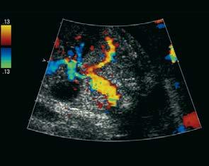 6 abnormal arterial supply abdominal aorta Fig.