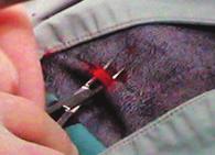 The sheath will peel apart leaving the catheter in position.