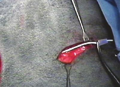 FIGURE 2 - THE PORT POCKET INCISION 2A 5C This end of the catheter connects to the port blue