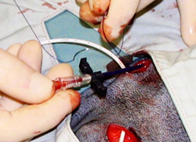 Peel-away sheath It consists of 2 components: - the inner introducer needle used to puncture the vessel and - the outer