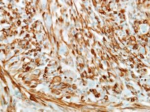 PNL2 + Melanoma Spindle cell