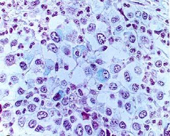 Markers CD 3+ T cell lymphoma Round cell neoplasm CD79a,