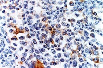 chains Plasma cell tumor Lysozyme, CD68, MAC 387