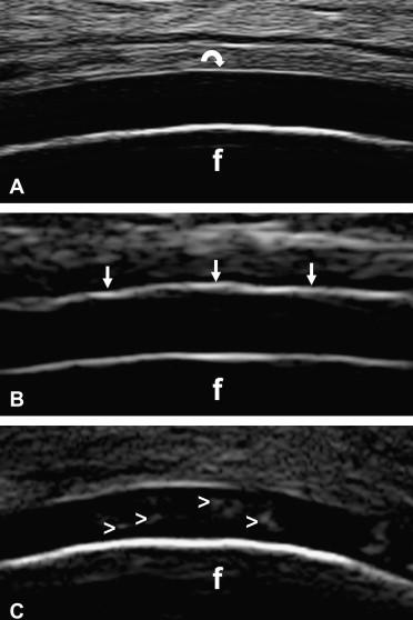 Ultrasound in CPPD versus Gout Normal hyaline cartilage of the femoral condyle disease Gout,