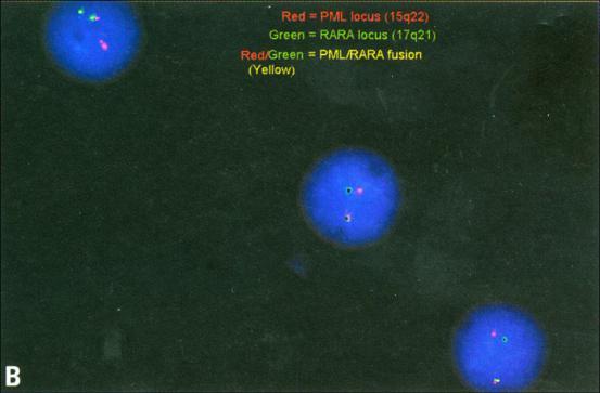 APL Cytogenetics/ Molecular Diagnosis Fusion Gene = PML-RARA Ancillary