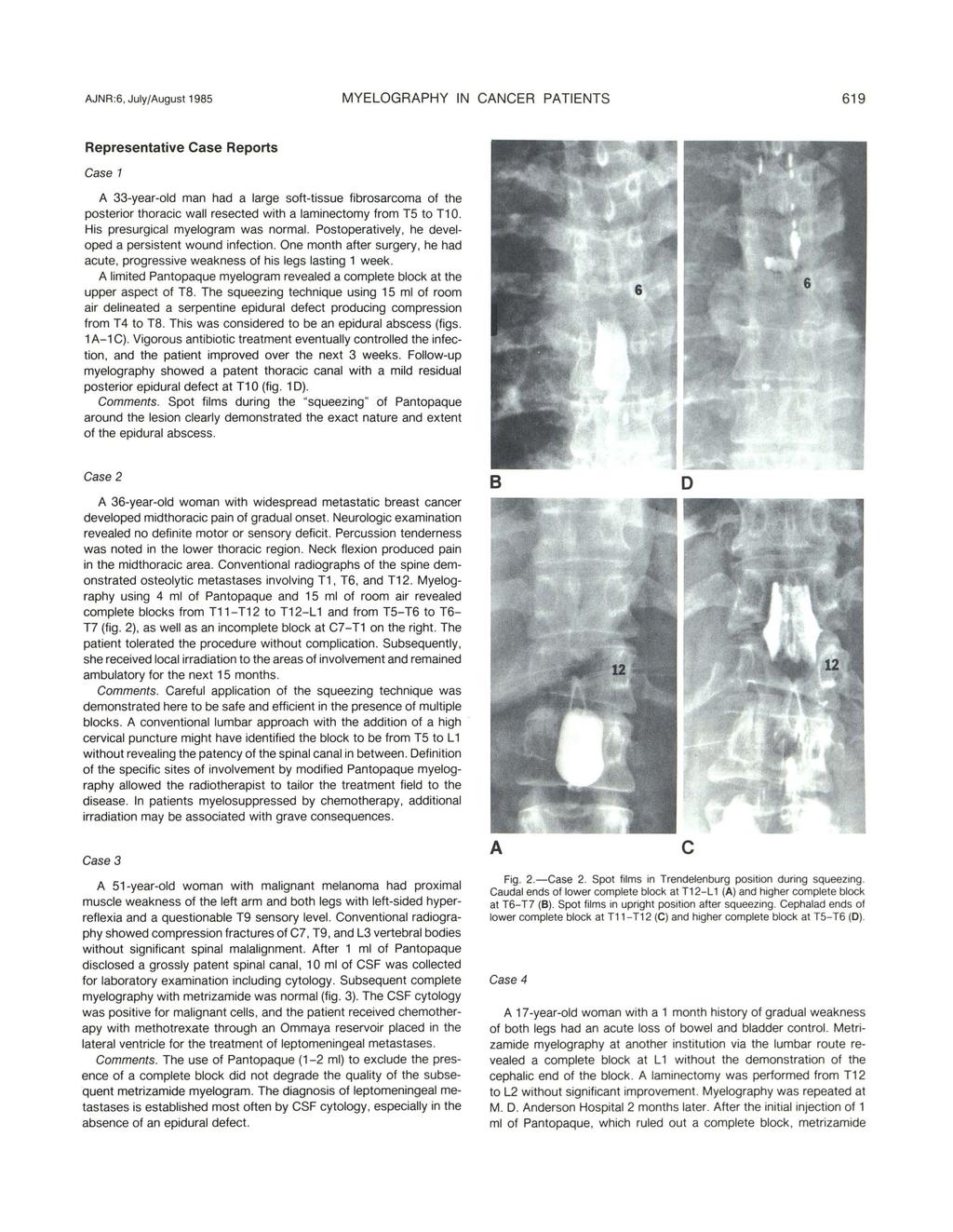 AJNR:6, July/August 1985 MYELOGRAPHY IN CANCER PATIENTS 619 Representative Case Reports Case 1 A 33-year-old man had a large soft-tissue fibrosarcoma of the posterior thoracic wall resected with a