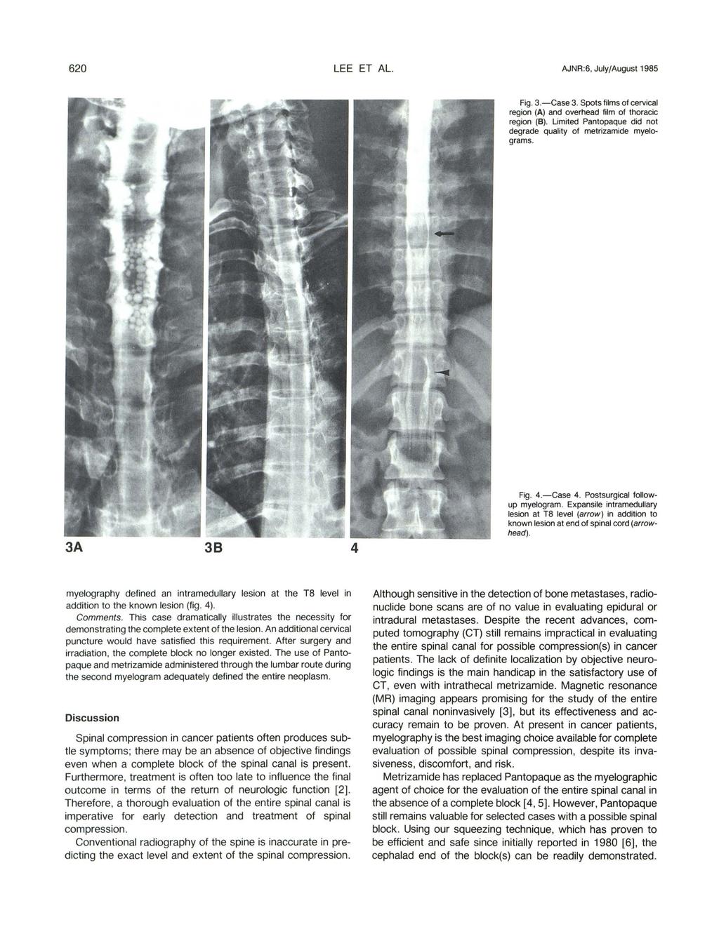 620 LEE ET AL. AJNR:6, July/August 1985 Fig. 3.-Case 3. spots films of cervical region (A) and overhead film of thoracic region (B).