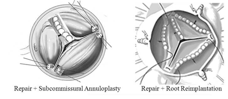 Nonaneurysmal root Aneurysmal root Repair