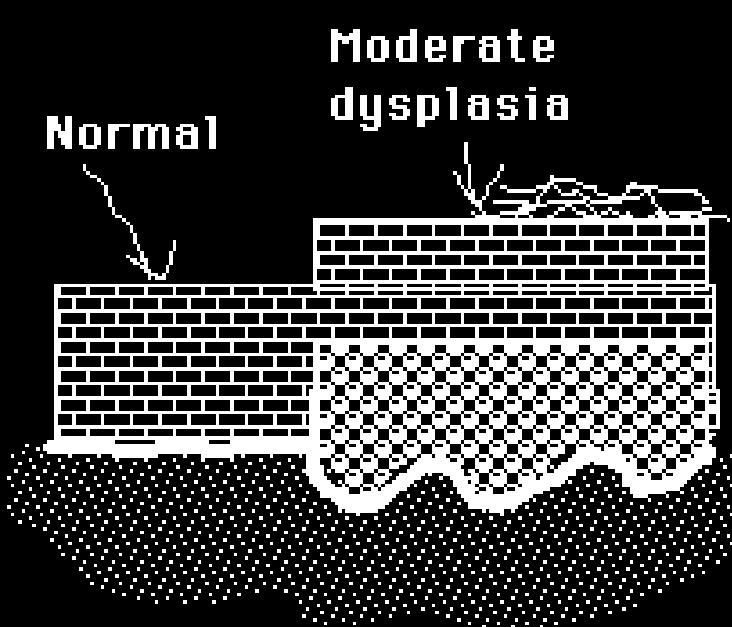 Moderate dysplasia Dysplastic cells