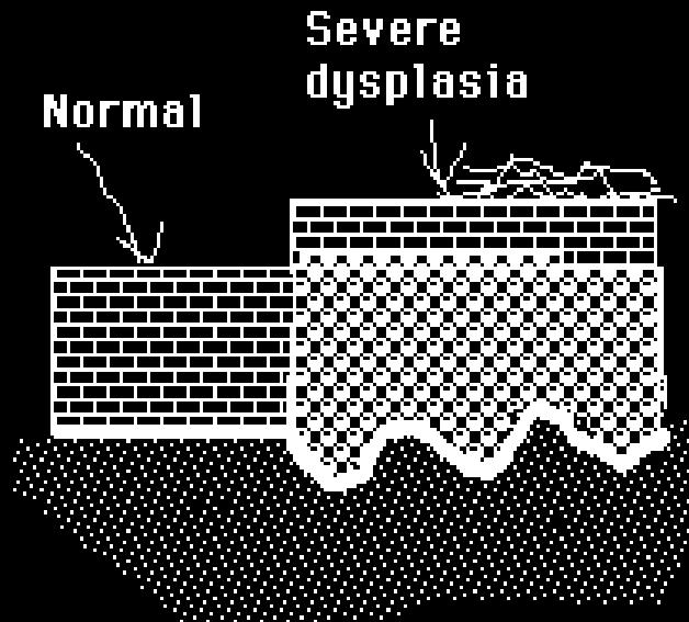 Severe dysplasia Dysplastic cells