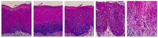 Histological progression model of oral lesions Hyperplasia Mild Dysplasia Moderate