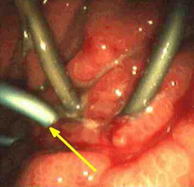 378 Brugge. Diagnosis and management of cystic lesions of the pancreas Figure 4 Endoscopic cystgastrostomy.